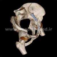 نمونه های جراحی شکستگی های دوستونی استابولوم. بررسی تخصصی 23 شکستگی ستون قدامی استابولوم لگن