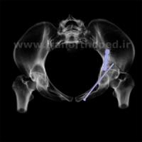نمونه های جراحی شکستگی های دوستونی استابولوم. بررسی تخصصی 28 شکستگی ستون قدامی استابولوم لگن