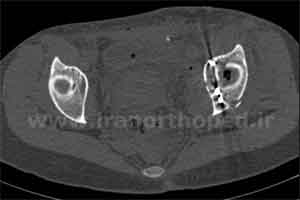 نمونه های جراحی شکستگی های دوستونی استابولوم. بررسی تخصصی 19 شکستگی ستون قدامی استابولوم لگن
