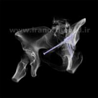 نمونه های جراحی شکستگی های دوستونی استابولوم. بررسی تخصصی 29 شکستگی ستون قدامی استابولوم لگن