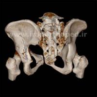 نمونه های جراحی شکستگی های دوستونی استابولوم. بررسی تخصصی 25 شکستگی ستون قدامی استابولوم لگن