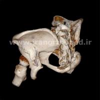 نمونه های جراحی شکستگی های دوستونی استابولوم. بررسی تخصصی 26 شکستگی ستون قدامی استابولوم لگن