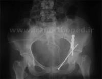 نمونه های جراحی شکستگی های دوستونی استابولوم. بررسی تخصصی 15 شکستگی ستون قدامی استابولوم لگن