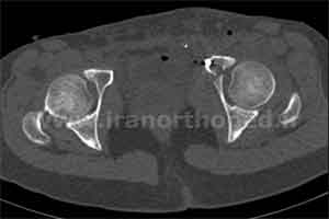 نمونه های جراحی شکستگی های دوستونی استابولوم. بررسی تخصصی 22 شکستگی ستون قدامی استابولوم لگن