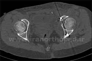 نمونه های جراحی شکستگی های دوستونی استابولوم. بررسی تخصصی 21 شکستگی ستون قدامی استابولوم لگن