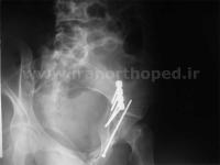 نمونه های جراحی شکستگی های دوستونی استابولوم. بررسی تخصصی 17 شکستگی ستون قدامی استابولوم لگن