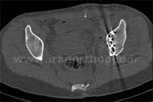 نمونه های جراحی شکستگی های دوستونی استابولوم. بررسی تخصصی 18 شکستگی ستون قدامی استابولوم لگن