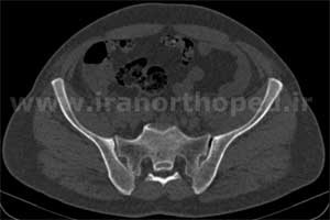 دررفتگی سمفیز پوبیس لگن