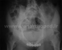 دررفتگی سمفیز پوبیس لگن