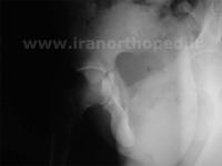 شکستگی ساکروم و استابولوم لگن