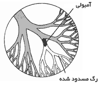 آمبولی ریوی