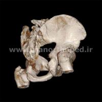 دررفتگی سمفیز پوبیس و مفصل ساکروایلیاک لگن