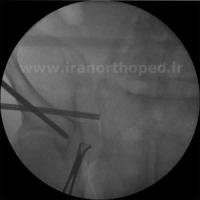 دررفتگی سمفیز پوبیس و مفصل ساکروایلیاک لگن
