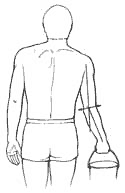 تغییر شکل مفصل آرنج. کوبیتوس والگوس و واروس 3 زاویه حمل یا Carrying angle