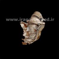 شکستگی دو طرفه ساکروم لگن
