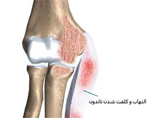 گلف البو یا آرنج گلف بازان