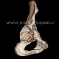 شکستگی تی استابولوم لگن