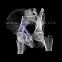 شکستگی تی استابولوم لگن