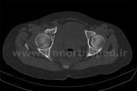 نمونه های جراحی شکستگی های دوستونی استابولوم. بررسی تخصصی 116 شکستگی دو ستونی استابولوم لگن