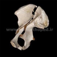 نمونه های جراحی شکستگی های دوستونی استابولوم. بررسی تخصصی 121 شکستگی دو ستونی استابولوم لگن