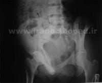 نمونه های جراحی شکستگی های دوستونی استابولوم. بررسی تخصصی 103 شکستگی دو ستونی استابولوم لگن