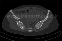 نمونه های جراحی شکستگی های دوستونی استابولوم. بررسی تخصصی 107 شکستگی دو ستونی استابولوم لگن