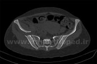 نمونه های جراحی شکستگی های دوستونی استابولوم. بررسی تخصصی 106 شکستگی دو ستونی استابولوم لگن
