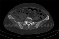 نمونه های جراحی شکستگی های دوستونی استابولوم. بررسی تخصصی 105 شکستگی دو ستونی استابولوم لگن