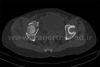 نمونه های جراحی شکستگی های دوستونی استابولوم. بررسی تخصصی 115 شکستگی دو ستونی استابولوم لگن