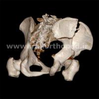 نمونه های جراحی شکستگی های دوستونی استابولوم. بررسی تخصصی 120 شکستگی دو ستونی استابولوم لگن