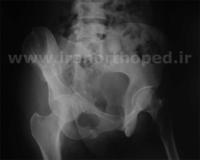 نمونه های جراحی شکستگی های دوستونی استابولوم. بررسی تخصصی 104 شکستگی دو ستونی استابولوم لگن
