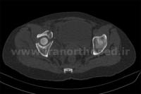 نمونه های جراحی شکستگی های دوستونی استابولوم. بررسی تخصصی 114 شکستگی دو ستونی استابولوم لگن