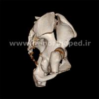 نمونه های جراحی شکستگی های دوستونی استابولوم. بررسی تخصصی 119 شکستگی دو ستونی استابولوم لگن