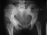 نمونه های جراحی شکستگی های دوستونی استابولوم. بررسی تخصصی 102 شکستگی دو ستونی استابولوم لگن