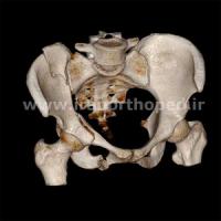 نمونه های جراحی شکستگی های دوستونی استابولوم. بررسی تخصصی 118 شکستگی دو ستونی استابولوم لگن