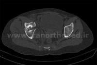 نمونه های جراحی شکستگی های دوستونی استابولوم. بررسی تخصصی 113 شکستگی دو ستونی استابولوم لگن