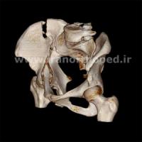 نمونه های جراحی شکستگی های دوستونی استابولوم. بررسی تخصصی 117 شکستگی دو ستونی استابولوم لگن