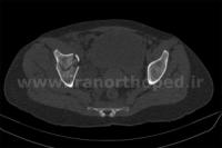 نمونه های جراحی شکستگی های دوستونی استابولوم. بررسی تخصصی 112 شکستگی دو ستونی استابولوم لگن