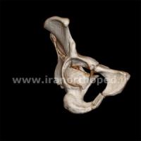نمونه های جراحی شکستگی های دوستونی استابولوم. بررسی تخصصی 122 شکستگی دو ستونی استابولوم لگن