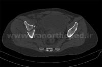 نمونه های جراحی شکستگی های دوستونی استابولوم. بررسی تخصصی 111 شکستگی دو ستونی استابولوم لگن