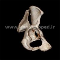 نمونه های جراحی شکستگی های دوستونی استابولوم. بررسی تخصصی 123 شکستگی دو ستونی استابولوم لگن