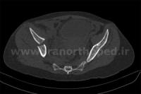 نمونه های جراحی شکستگی های دوستونی استابولوم. بررسی تخصصی 110 شکستگی دو ستونی استابولوم لگن