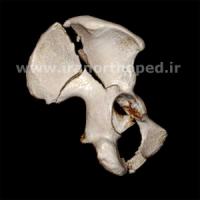 نمونه های جراحی شکستگی های دوستونی استابولوم. بررسی تخصصی 124 شکستگی دو ستونی استابولوم لگن