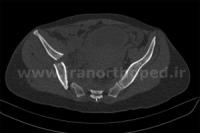 نمونه های جراحی شکستگی های دوستونی استابولوم. بررسی تخصصی 109 شکستگی دو ستونی استابولوم لگن