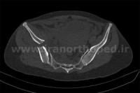 نمونه های جراحی شکستگی های دوستونی استابولوم. بررسی تخصصی 108 شکستگی دو ستونی استابولوم لگن