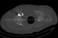 نمونه های جراحی شکستگی های دوستونی استابولوم. بررسی تخصصی 136 شکستگی دو ستونی استابولوم لگن
