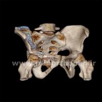 نمونه های جراحی شکستگی های دوستونی استابولوم. بررسی تخصصی 139 شکستگی دو ستونی استابولوم لگن