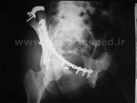 نمونه های جراحی شکستگی های دوستونی استابولوم. بررسی تخصصی 126 شکستگی دو ستونی استابولوم لگن