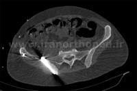 نمونه های جراحی شکستگی های دوستونی استابولوم. بررسی تخصصی 129 شکستگی دو ستونی استابولوم لگن