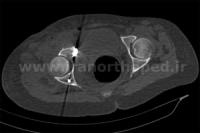 نمونه های جراحی شکستگی های دوستونی استابولوم. بررسی تخصصی 135 شکستگی دو ستونی استابولوم لگن